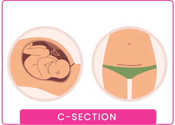 Cesarean Section