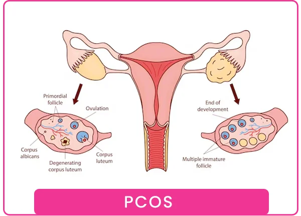 PCOS