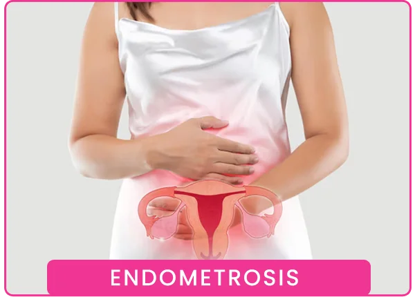 Endometriosis