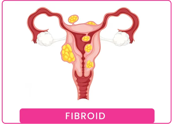 Fibroid
