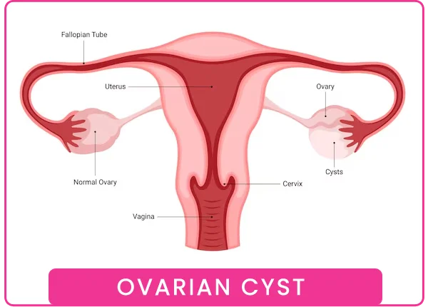 Ovarian Cyst